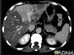 Liver with disproportional fattening - CT scan