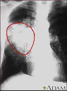 Lung cancer - frontal chest X-ray