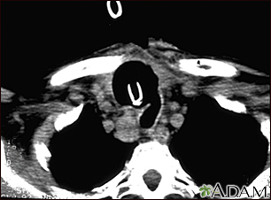 Thyroid cancer - CT scan