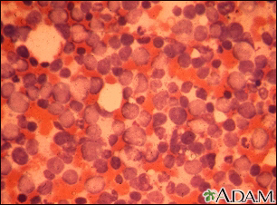 Chronic myelocytic leukemia