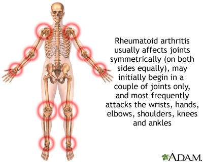 Rheumatoid arthritis