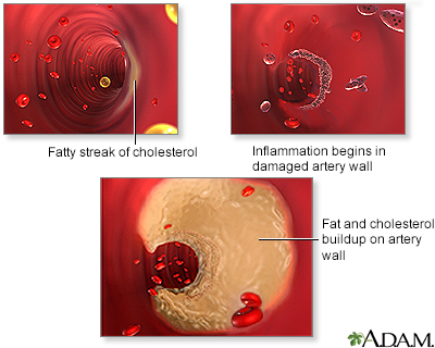 Arterial plaque build-up