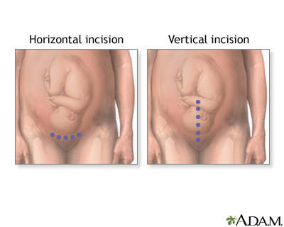 C-Section