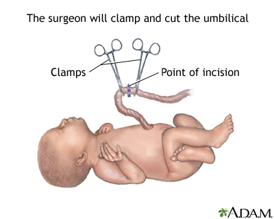 C-Section