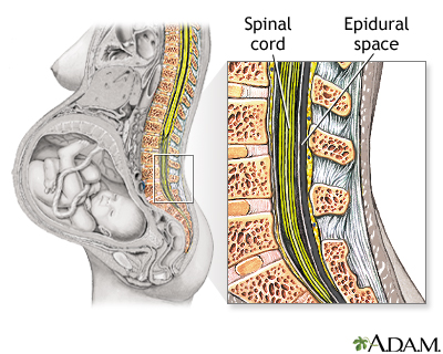 Procedure - Epidural 1