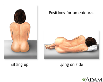 Procedure - Epidural 2