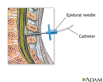 Procedure - Epidural 4