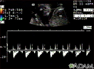 Ultrasound, normal fetus - heartbeat