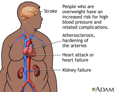 Obesity and health