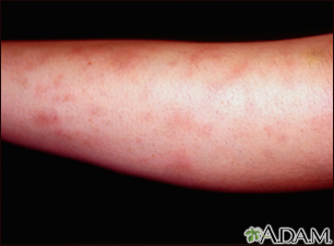 Erythema nodosum associated with sarcoidosis