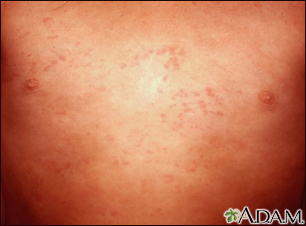 Hives (urticaria) on the chest