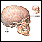 Craniotomy - series